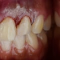 The Science Behind Non-Surgical Gummy Smile Correction: A Medical Perspective