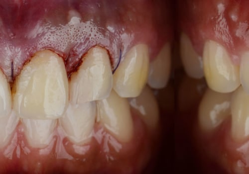 The Science Behind Non-Surgical Gummy Smile Correction: A Medical Perspective